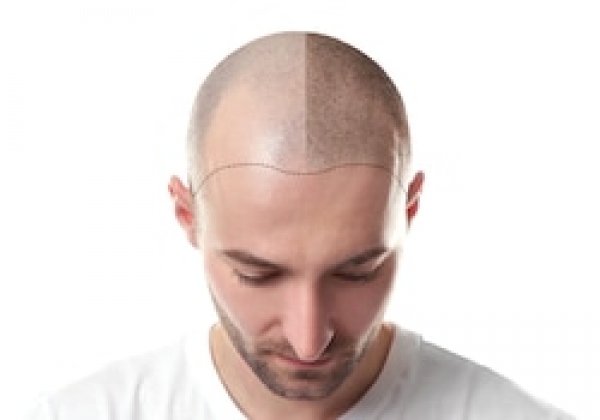 Microdot hair 